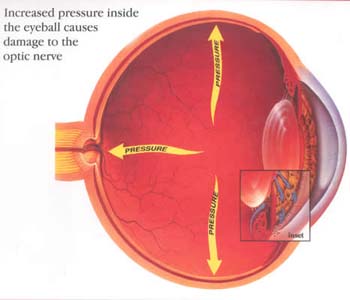 Early Signs Of Glaucoma Occurs In Brain