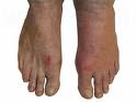 Scientists Identify New Genes That Could Lead To Gout