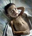 80 Infants In Tribal MP Die Of Malnutrition 