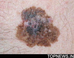 8 genes that help predict melanoma patient''s response to treatment identified