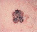 Gene With Melanoma Link