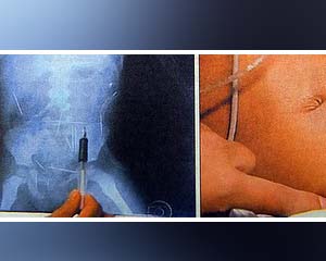More needles removed from Brazilian tot’s body