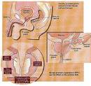 Bloodless Operation For Enlarged Prostate Available At Sagar Hospital