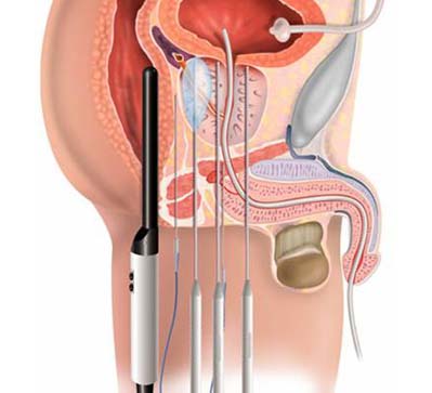 Prostate cancer therapy ‘ups risk of bone, heart-related problems’