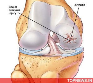 New therapeutic target for rheumatoid arthritis identified