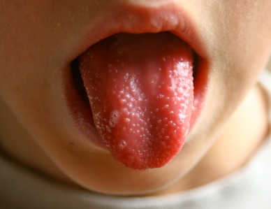 Scarlet fever hits a record high in 32 years