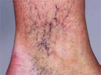 Dermatologists use spider veins’ treatment to improve ageing hands’ appearance