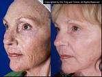 Sun-Damaged Skin Can Be Improved By Laser Treatment 