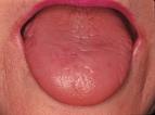 Tongue feels sour taste only after saliva has wiped it off