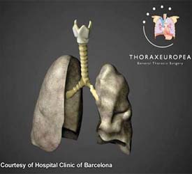 Transplanted windpipe working well for British boy