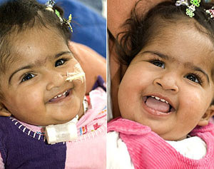 Bangladeshi conjoined twins begin separate lives