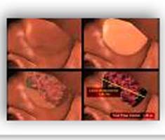 Promises shown by 'Virtual biopsy' colonoscopy