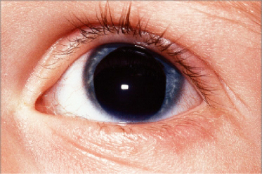 Potential cure for rare eye disease developed