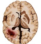 Brain-tumour