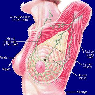 Invasive breast cancer often overdiagnosed 