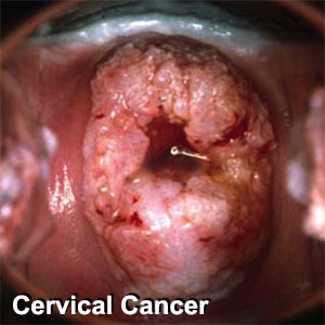 HPV Vaccine to prevent Cervical Cancer