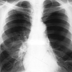 US researchers identifies the test for smokers at risk of emphysema