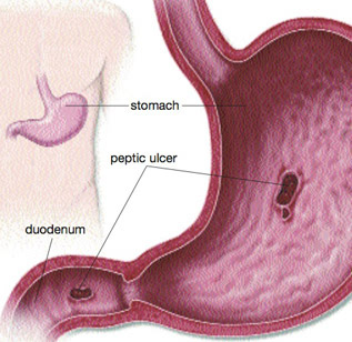 Childhood adversities may help predict gastric ulcer | TopNews