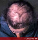 Fathers can pass on hair loss genes to sons