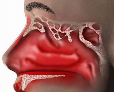 Health conditions worsens in case of hayfever patients