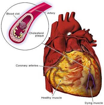 Five-in-one combo pill for reducing heart attacks by more than 50 percent!