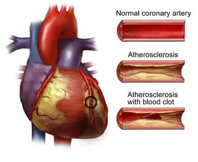 Study: Obese Kids' Arteries could be as clogged as Old People’s Arteries