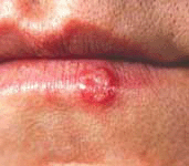 Herpes Virus