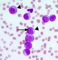 American Researchers Identify Eight Genes That Could Be Causing Leukemia