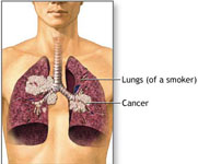 Lung Cancer