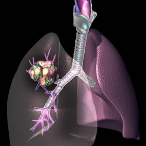 Research is on over a viral therapy for a lethal lung cancer