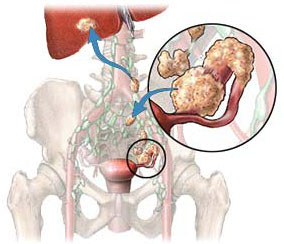 Malignant Tumour