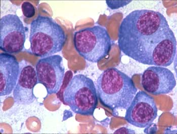 Novel Discovery Paves Way For Treatment Of Multiple Myeloma