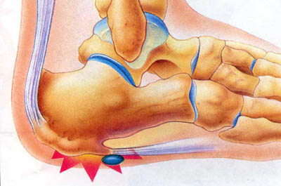 Study offers new treatment to plantar fasciitis patients
