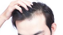 How to stop Hair Loss and Hair Thinning