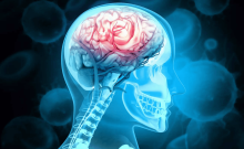 Progressive Supranuclear Palsy Could be Detected Earlier with Skin Test: University of Toronto Research